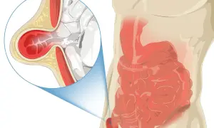 Illustration médicale montrant une hernie inguinale, où une partie de l'intestin sort de la paroi abdominale.