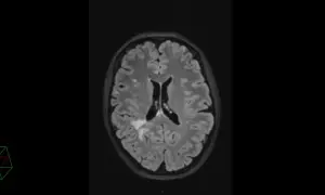 IRM cérébrale montrant des hypersignaux de la substance blanche, potentiellement liés au stress chronique ou à d'autres facteurs vasculaires.