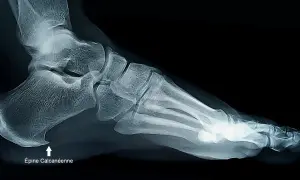 Radiographie latérale du pied montrant une épine calcanéenne, une excroissance osseuse au talon.