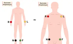 Schéma montrant le placement des électrodes périphériques pour un ECG.