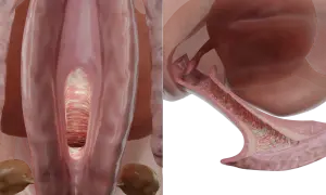 Vue anatomique du vagin montrant des signes de mycose vulvaire, avec des dépôts blanchâtres et une inflammation.