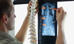Un médecin examine une radiographie montrant une scoliose. La courbure vertébrale peut affecter l'espérance de vie.