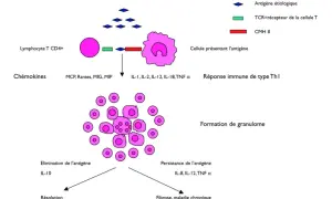Schéma illustrant la formation de granulomes, un symptôme de la sarcoïdose, impliquant des lymphocytes T et des cellules présentant l'antigène.
