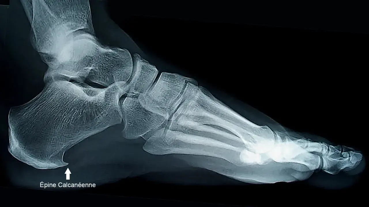 Radiographie latérale du pied montrant une épine calcanéenne, une excroissance osseuse au talon.