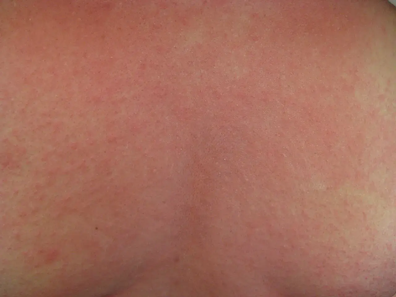 Peau rougie et irritée, parsemée de petites taches rouges. Cela pourrait être un signe d'une réaction allergique sévère, comme un choc anaphylactique.