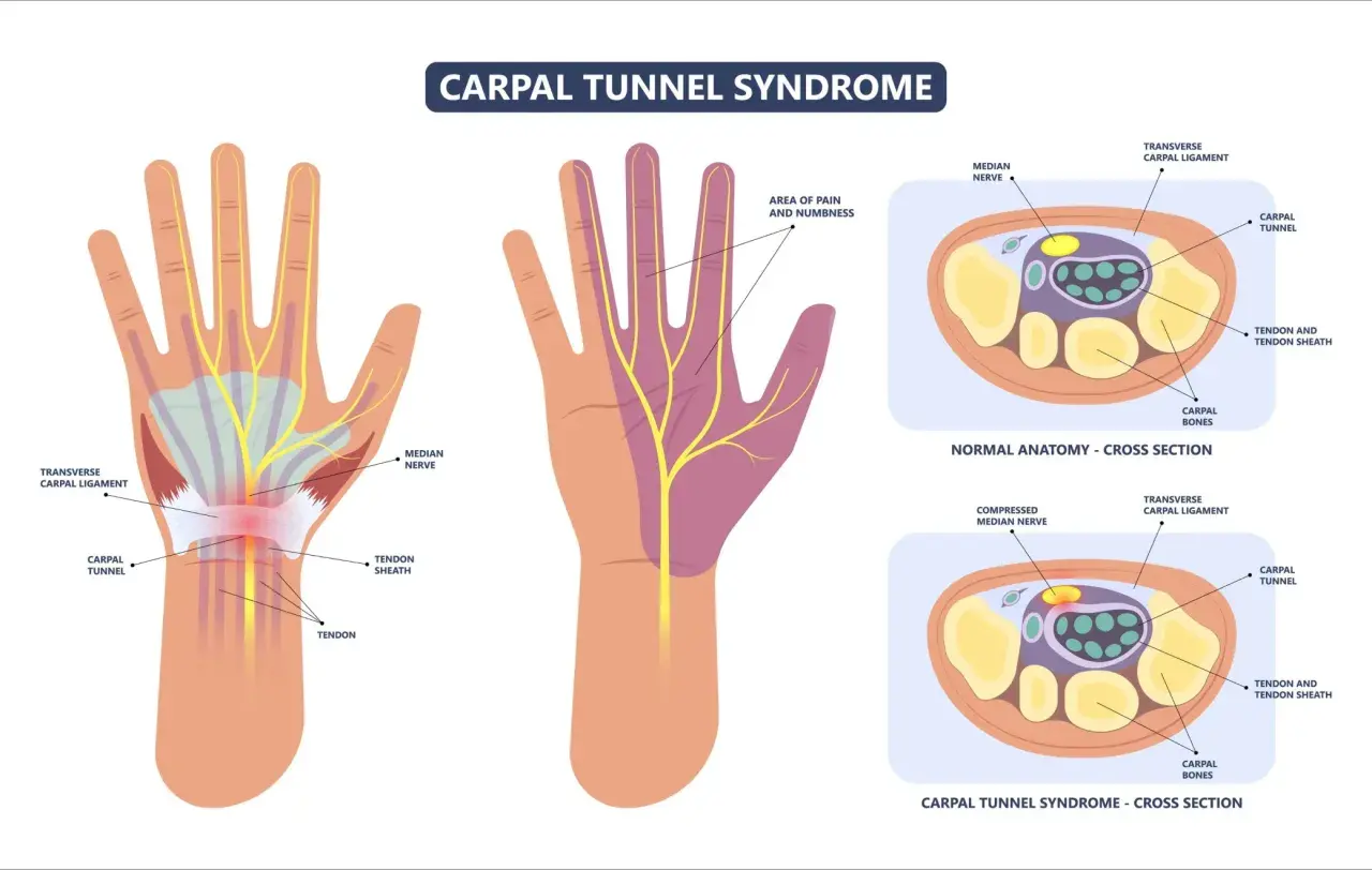 Illustration du syndrome du canal carpien : compression du nerf médian dans le canal carpien, causant douleur et engourdissement.