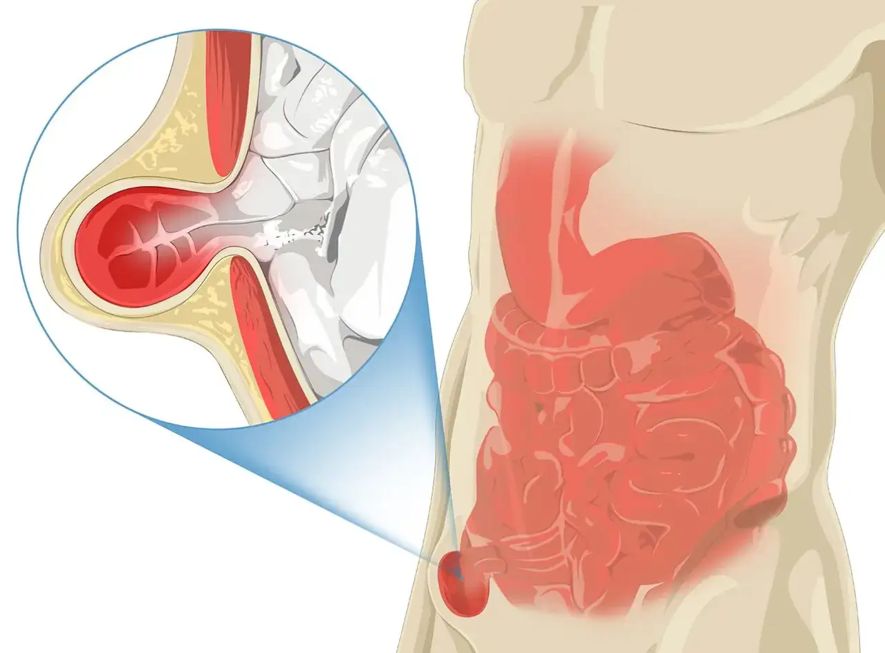 Illustration médicale montrant une hernie inguinale, où une partie de l'intestin sort de la paroi abdominale.