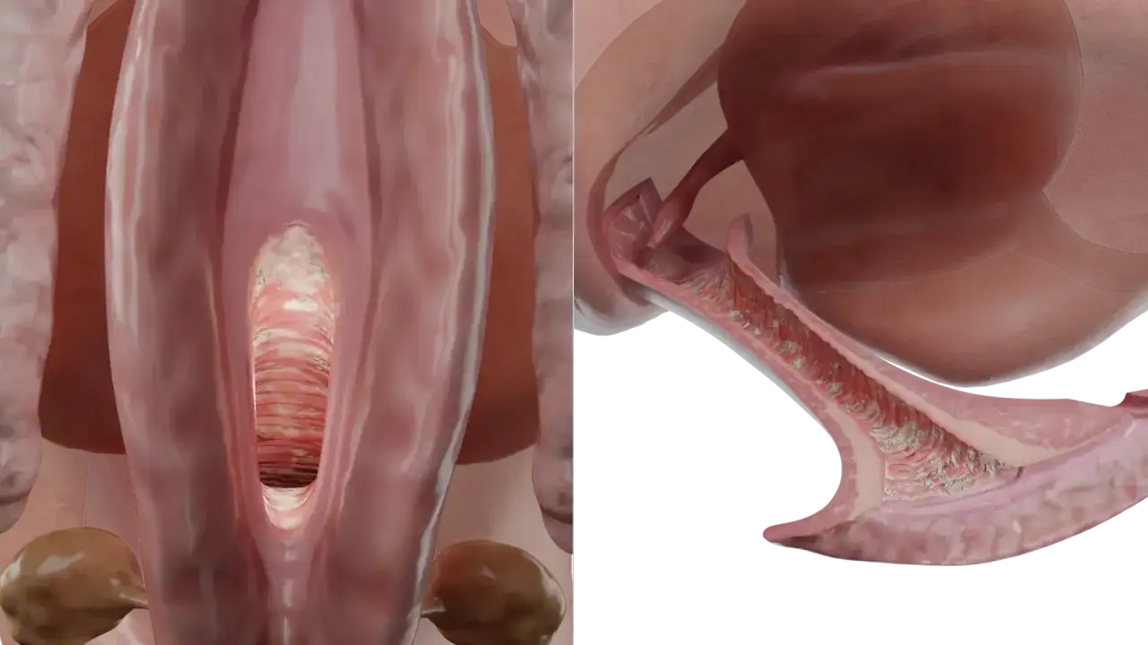 Vue anatomique du vagin montrant des signes de mycose vulvaire, avec des dépôts blanchâtres et une inflammation.