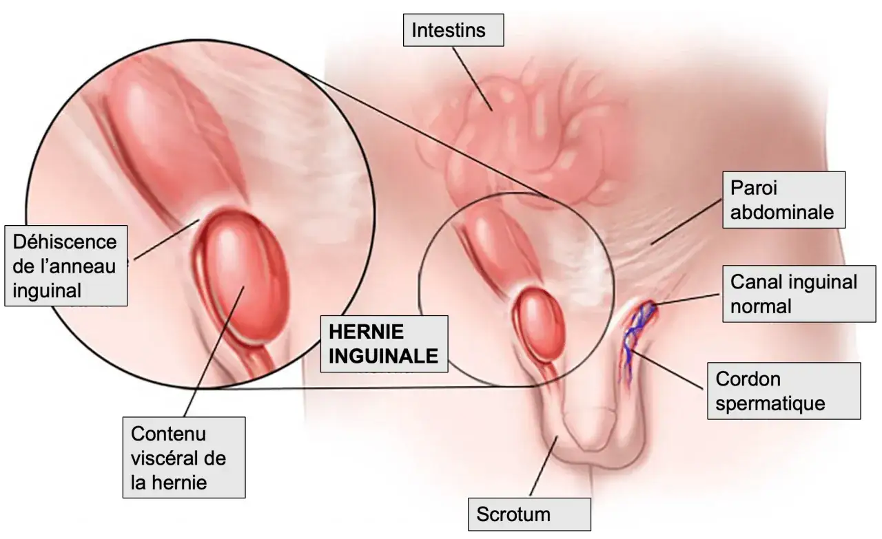 Illustration d'une hernie inguinale montrant des intestins sortant par une faiblesse de la paroi abdominale, dans le canal inguinal.