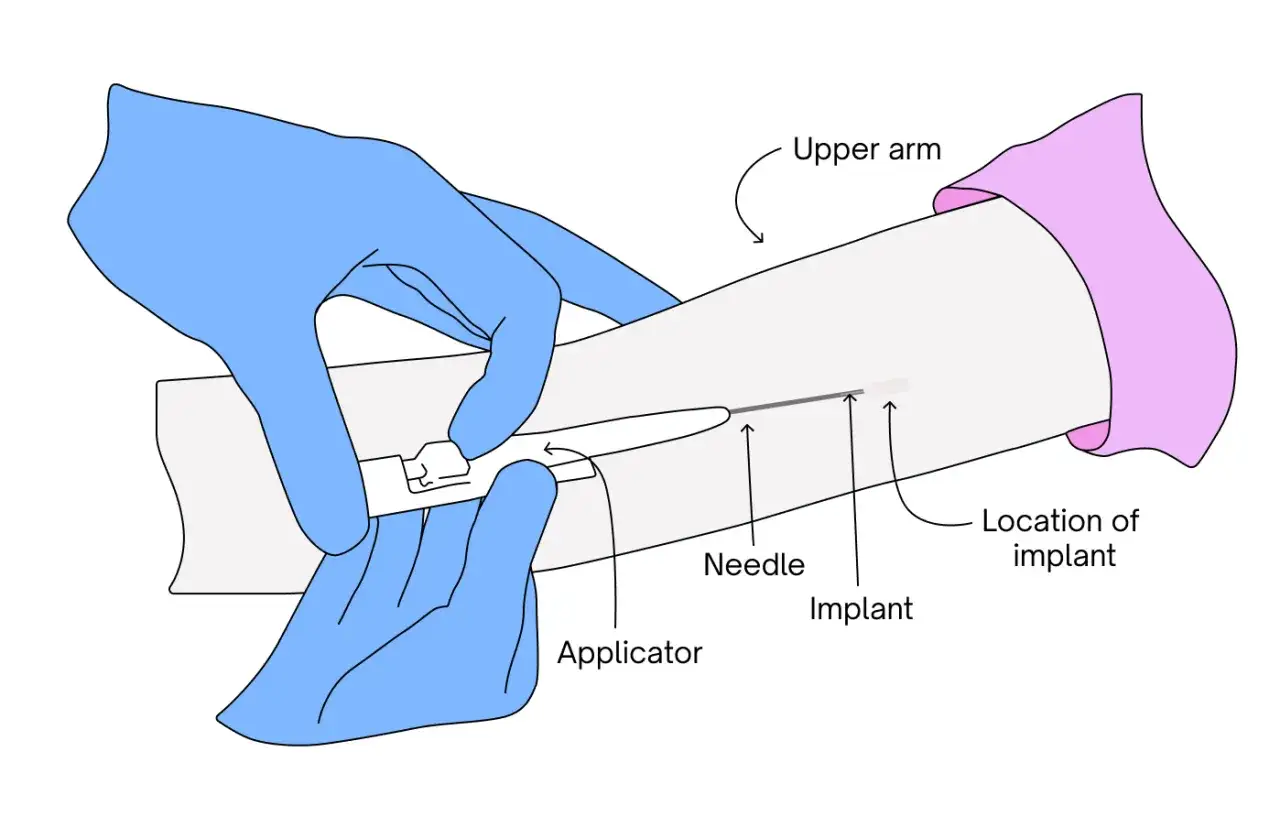 Pose d'un implant contraceptif sous la peau du bras à l'aide d'un applicateur et d'une aiguille.