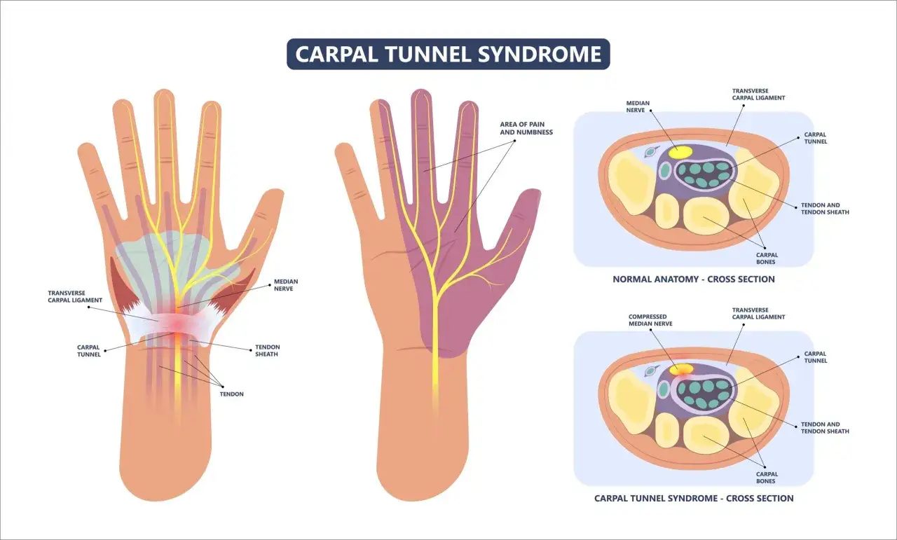 Illustration du syndrome du canal carpien : un nerf médian comprimé dans le poignet, causant douleur et engourdissement.