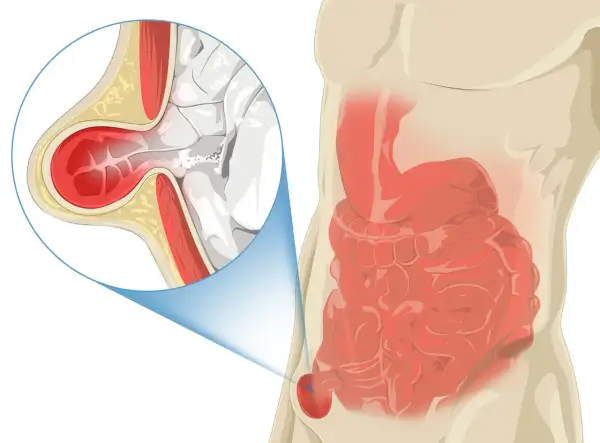 Illustration médicale montrant une hernie inguinale, où une partie de l'intestin sort de la paroi abdominale.