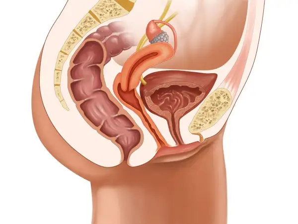 Illustration anatomique du pelvis féminin montrant le rectum, la vessie, l'utérus et les ligaments. Une condition comme le prolapsus vaginal peut affecter ces organes.