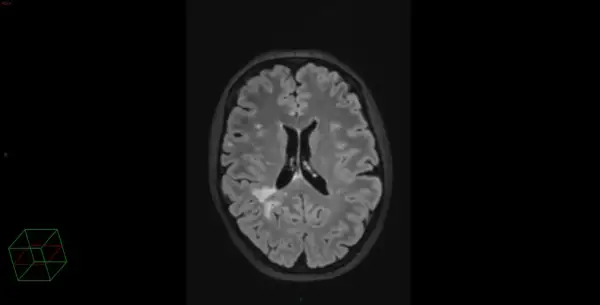 IRM cérébrale montrant des hypersignaux de la substance blanche, potentiellement liés au stress chronique ou à d'autres facteurs vasculaires.