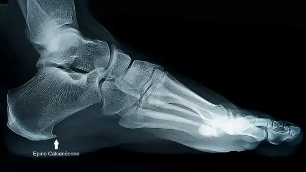 Radiographie latérale du pied montrant une épine calcanéenne, une excroissance osseuse au talon.