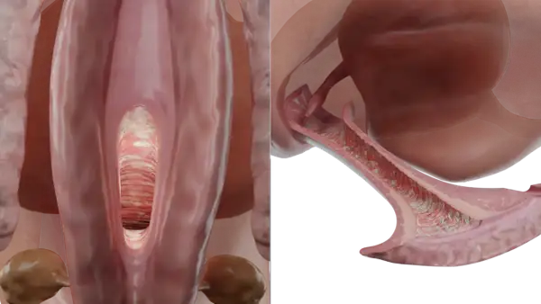 Vue anatomique du vagin montrant des signes de mycose vulvaire, avec des dépôts blanchâtres et une inflammation.
