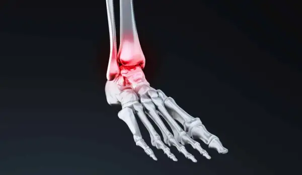 Anatomie du pied humain, mettant en évidence l'astragale os et les zones enflammées en rouge.