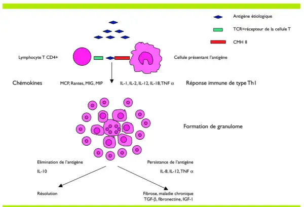 Schéma illustrant la formation de granulomes, un symptôme de la sarcoïdose, impliquant des lymphocytes T et des cellules présentant l'antigène.